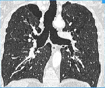 ESTUDO DO EFEITO DO CPAP NA S�NDROME DE MOUNIER-KUHN: ENCAMINHE SEU PACIENTE.